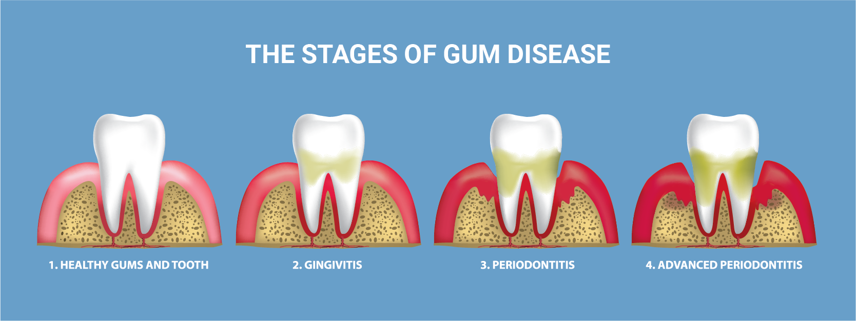 Not Flossing Your Teeth